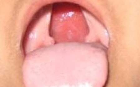 Free Cleft Lip and Palate Surgery Registration Camp to Begin in Raebareli from July 21